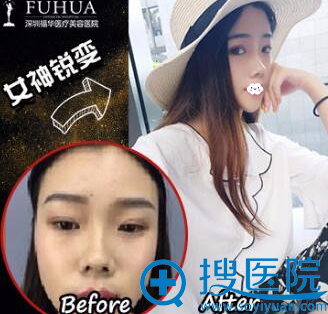 <!--<i data=20240710 data-id=13979></i>-->鼻综合隆鼻真人案例前后效果对比 <!--<i data=20240710 data-id=13979></i>-->鼻综合隆鼻真人案例前后效果对比