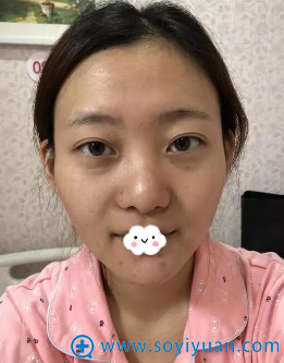 怎样能改变气质?我做假体隆鼻综合整形3个月后换来美丽余生