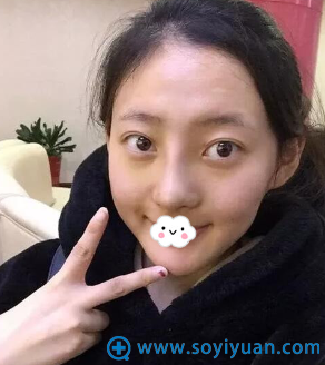 驻马店美兰德整形美容医院鼻综合隆鼻案例 驻马店美兰德整形美容医院鼻综合隆鼻案例