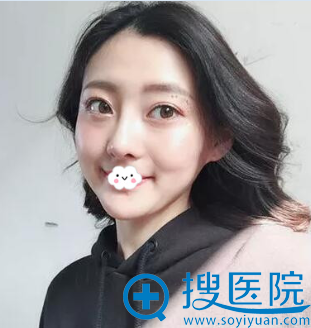 假体隆鼻综合整形真实恢复过程 假体隆鼻综合整形真实恢复过程
