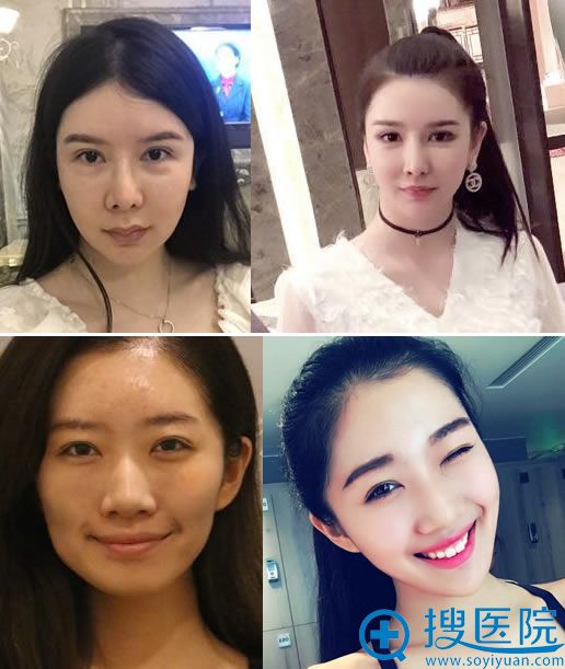 北京润美玉之光王明利自体脂肪填充案例 北京润美玉之光王明利自体脂肪填充案例