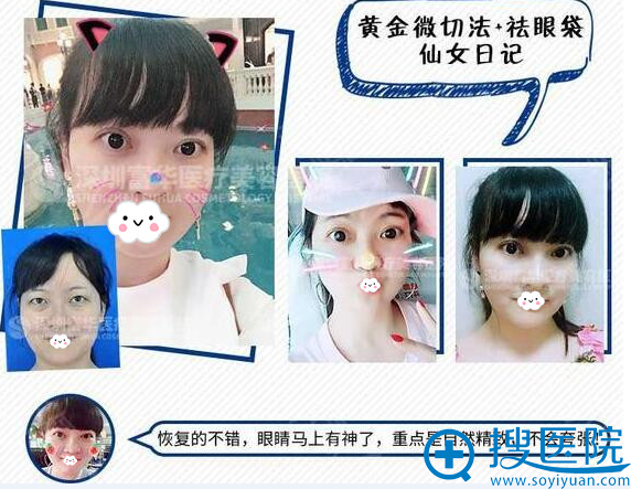 深圳富华双眼皮整形真人案例 深圳富华双眼皮整形真人案例