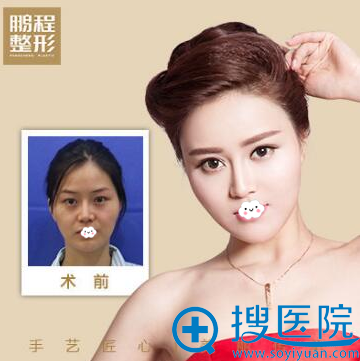 深圳鹏程双眼皮真人案例效果图 深圳鹏程双眼皮真人案例效果图