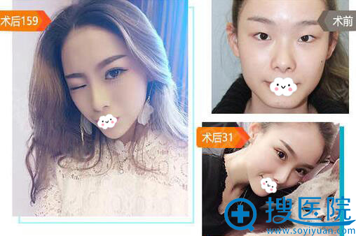 <!--<i data=20240710 data-id=12503></i>-->双眼皮怎么样?眼综合真人案例对比图 <!--<i data=20240710 data-id=12503></i>-->双眼皮怎么样?眼综合真人案例对比图
