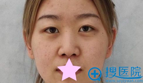 <!--<i data=20240710 data-id=9376></i>-->整形医院割双眼皮+综合隆鼻前 <!--<i data=20240710 data-id=9376></i>-->整形医院割双眼皮+综合隆鼻前