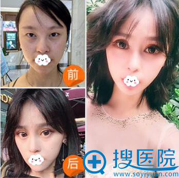 <!--<i data=20240710 data-id=12014></i>-->医疗美容门诊部双眼皮案例 <!--<i data=20240710 data-id=12014></i>-->医疗美容门诊部双眼皮案例
