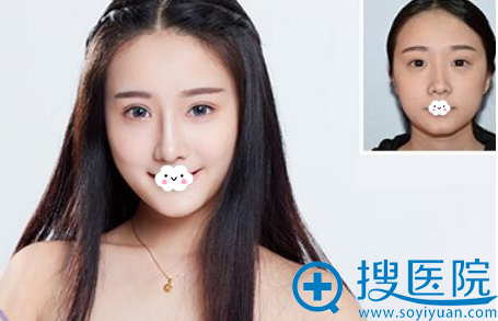 深圳江南春天双眼皮整形案例 深圳江南春天双眼皮整形案例