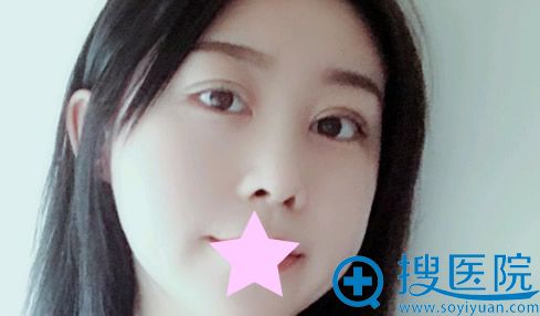 割双眼皮+鼻综合隆鼻半个月恢复效果 割双眼皮+鼻综合隆鼻半个月恢复效果