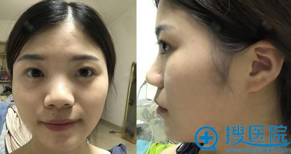 综合衡阳雅美王晓朋和廖伟龙隆鼻案例和价格选择王晓朋做鼻综合