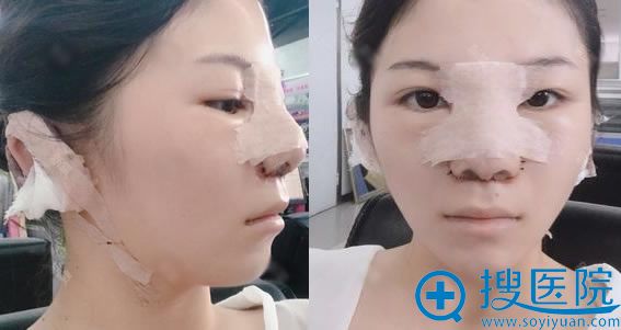 刚做完耳软骨和假体隆鼻图片 刚做完耳软骨和假体隆鼻图片