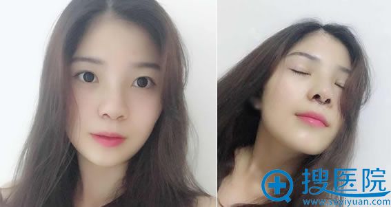 做完隆鼻手术8天拆线效果图 做完隆鼻手术8天拆线效果图