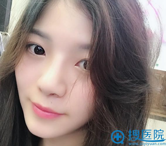 选择衡阳雅美王晓朋做隆鼻15天后 选择衡阳雅美王晓朋做隆鼻15天后