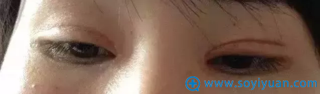 双眼皮整形失败案例 双眼皮整形失败案例