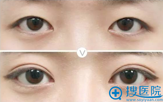 双眼皮真人案例效果对比图 双眼皮真人案例效果对比图