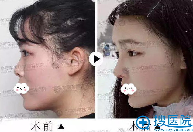 案例图带你了解自体肋软骨隆鼻的优点,为何大家不选假体隆鼻?