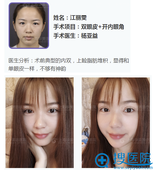 上海华美<!--<i data=20240710 data-id=16301></i>-->做的全切双眼皮案例 上海华美<!--<i data=20240710 data-id=16301></i>-->做的全切双眼皮案例