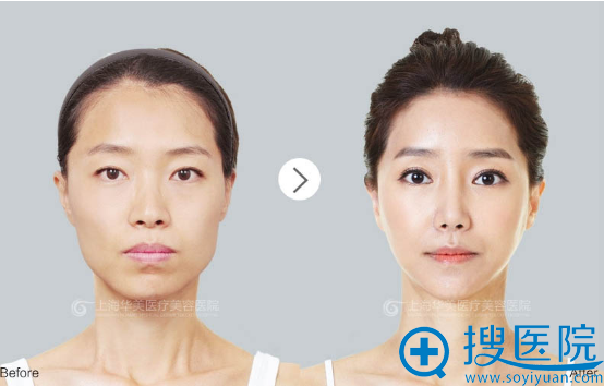 上海华美<!--<i data=20240710 data-id=16294></i>-->做的韩式双眼皮案例 上海华美<!--<i data=20240710 data-id=16294></i>-->做的韩式双眼皮案例