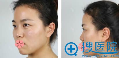 我去石家庄美联臣和贵美人看过价格后,去雅芳亚做了假体隆鼻