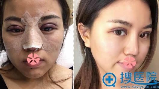 做完双眼皮和假体隆鼻即刻效果和5天后拆掉鼻夹的照片 做完双眼皮和假体隆鼻即刻效果和5天后拆掉鼻夹的照片