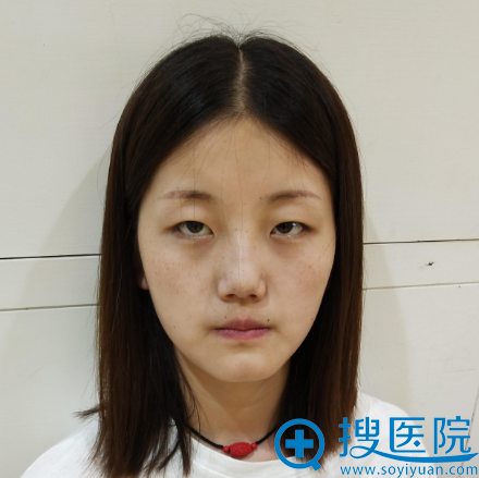 看了上海华美杨亚益和佀同帅的案例后决定找佀同帅做全切双眼皮
