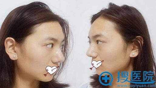 没有在<!--<i data=20240710 data-id=10206></i>-->连天美做V-LINE瓜子脸手术前样子 没有在<!--<i data=20240710 data-id=10206></i>-->连天美做V-LINE瓜子脸手术前样子
