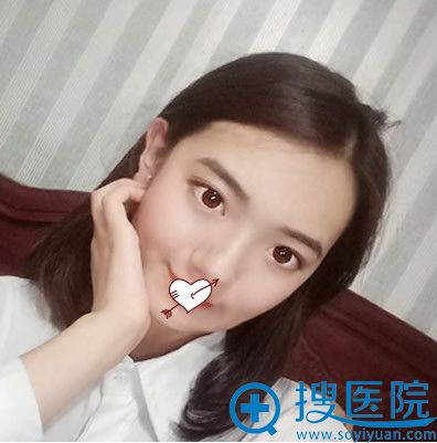 在<!--<i data=20240710 data-id=10206></i>-->连天美做V-LINE瓜子脸手术后第19天恢复情况 在<!--<i data=20240710 data-id=10206></i>-->连天美做V-LINE瓜子脸手术后第19天恢复情况