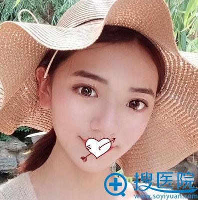 <!--<i data=20240710 data-id=10206></i>-->连天美V-LINE瓜子脸手术后第88天恢复效果 <!--<i data=20240710 data-id=10206></i>-->连天美V-LINE瓜子脸手术后第88天恢复效果
