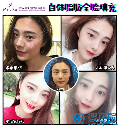 �人��������ҽԺ��������֬�������ά�ֶ�ã���ȫ����䰸��