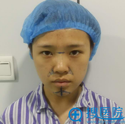双眼皮隆鼻手术前 双眼皮隆鼻手术前