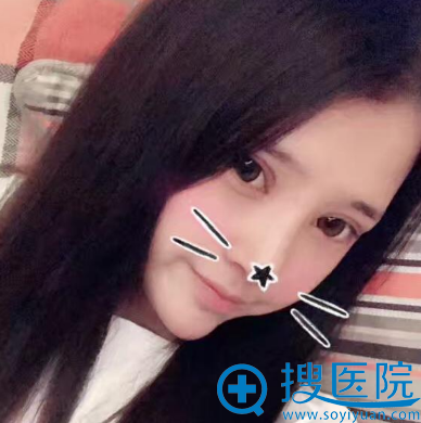 双眼皮隆鼻术后12天 双眼皮隆鼻术后12天