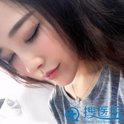 双眼皮隆鼻和脂肪填充一个月恢复<span style= 双眼皮隆鼻和脂肪填充一个月恢复<span style=