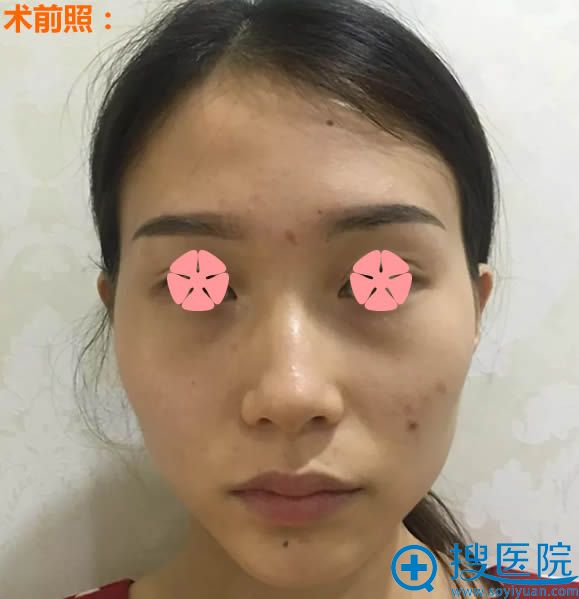 写一篇我让义乌张小红做假体隆鼻和自体脂肪填充全脸的个人经历