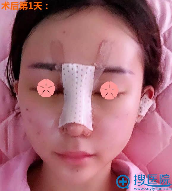 自体脂肪填充全脸术后第1天 自体脂肪填充全脸术后第1天