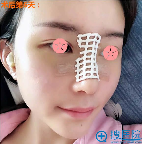 假体隆鼻第6天拆线后的样子 假体隆鼻第6天拆线后的样子