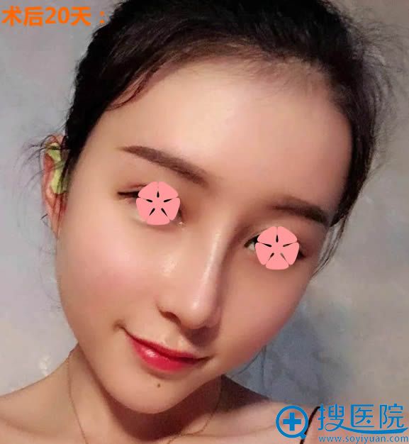 在义乌张小红做完脂肪填充全脸和假体隆鼻的恢复照 在义乌张小红做完脂肪填充全脸和假体隆鼻的恢复照