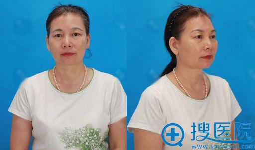 分享奶奶坚持选择北京华韩医院做切眉术后24天全过程照片