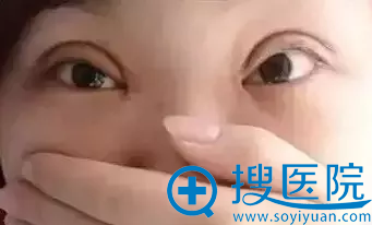 双眼皮失败案例 双眼皮失败案例
