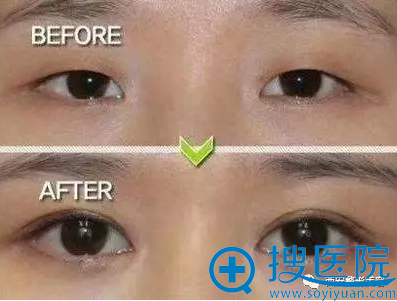 想要好的双眼皮术后效果通过眼部综合整形完成 想要好的双眼皮术后效果通过眼部综合整形完成