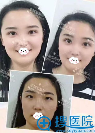 难度系数较大的双眼皮整形要开眼角 难度系数较大的双眼皮整形要开眼角
