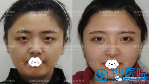 真人案例展示如何避免双眼皮整形失败 真人案例展示如何避免双眼皮整形失败