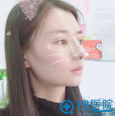在苏州紫馨做完双眼皮隆鼻一周了 在苏州紫馨做完双眼皮隆鼻一周了