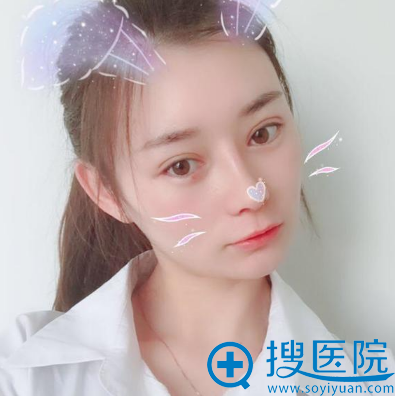 苏州紫馨孙军做的双眼皮案例 苏州紫馨孙军做的双眼皮案例