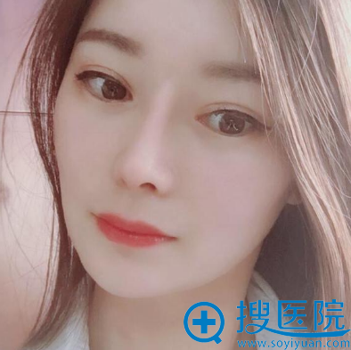 苏州紫馨赵延峰做的全肋软骨鼻综合隆鼻案例 苏州紫馨赵延峰做的全肋软骨鼻综合隆鼻案例