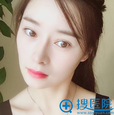 苏州紫馨整形医院孙军双眼皮隆鼻案例 苏州紫馨整形医院孙军双眼皮隆鼻案例