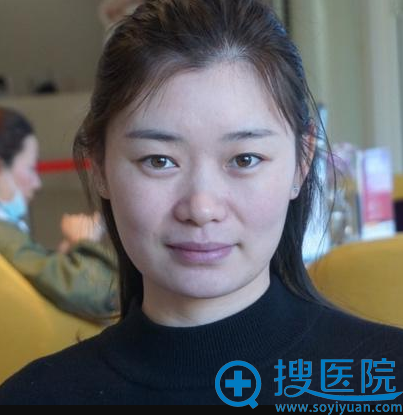 对比苏州紫馨和美莱的案例价格后找孙军/赵延峰做了双眼皮隆鼻