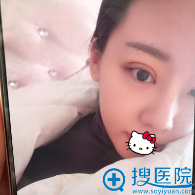 纠结了2年 我终于在济南美莲整形医院找韩旭做了切开双眼皮