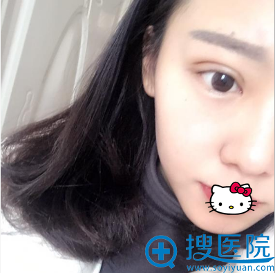 双眼皮术后6天恢复照片 双眼皮术后6天恢复照片