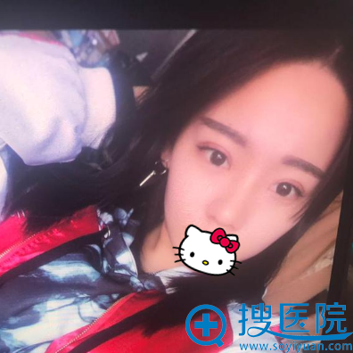 济南美莲韩旭双眼皮术后10天 济南美莲韩旭双眼皮术后10天