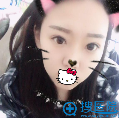 济南美莲切开双眼皮术后效果 济南美莲切开双眼皮术后效果