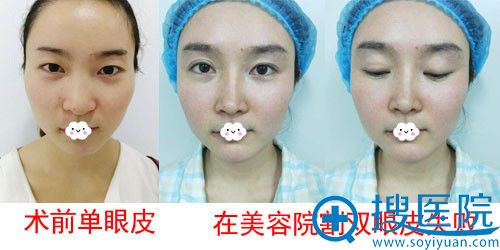 成都<!--<i data=20240710 data-id=16572></i>-->眼整形与修复医学研究院双眼皮失败修复案例 成都<!--<i data=20240710 data-id=16572></i>-->眼整形与修复医学研究院双眼皮失败修复案例